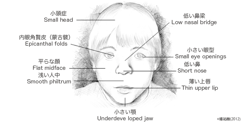 胎児性アルコール症候群 E ヘルスネット 厚生労働省