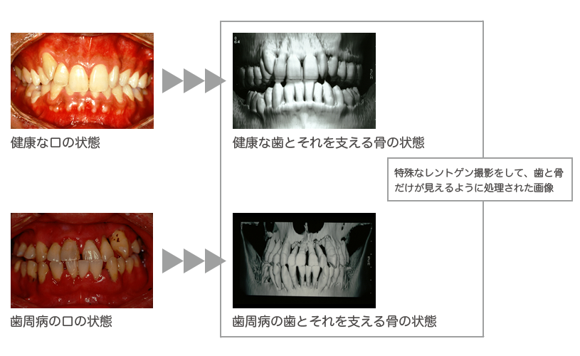 健康な状態と歯周病の比較