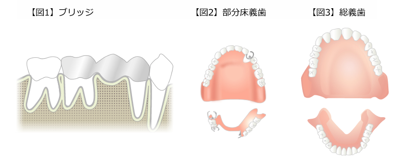 喪失した歯を補う治療（補てつ）